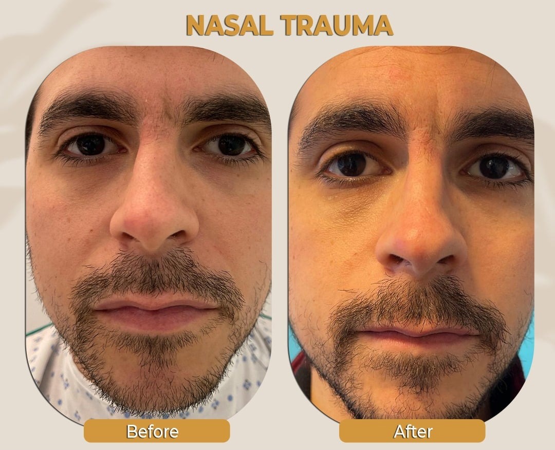 Facial Surgery