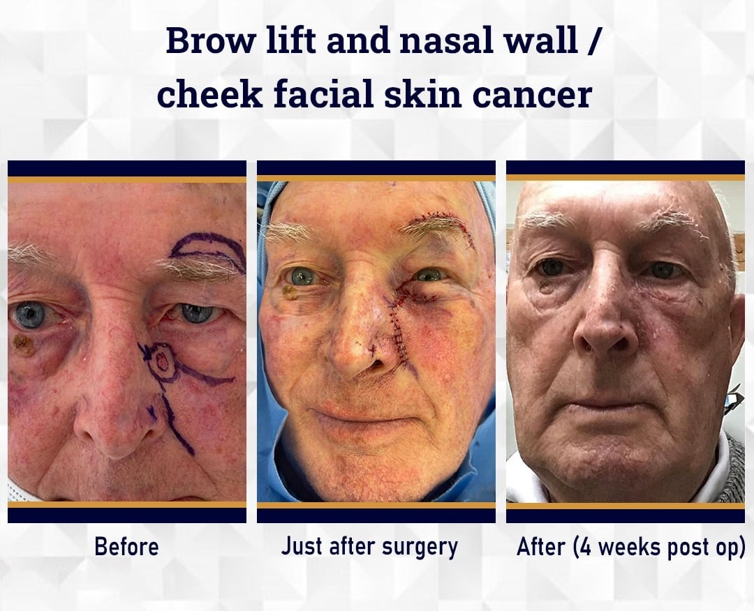 Facial Surgery