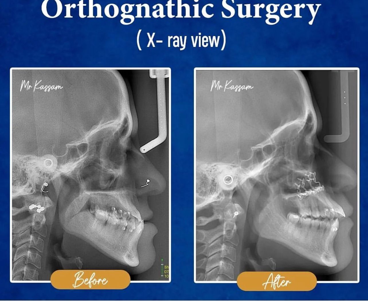 Facial Surgery