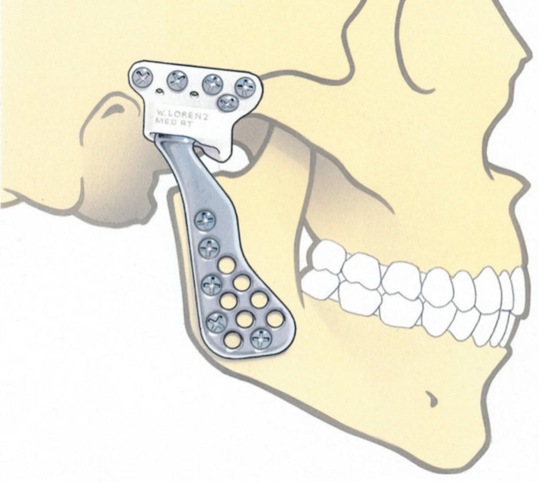 Facial Surgery